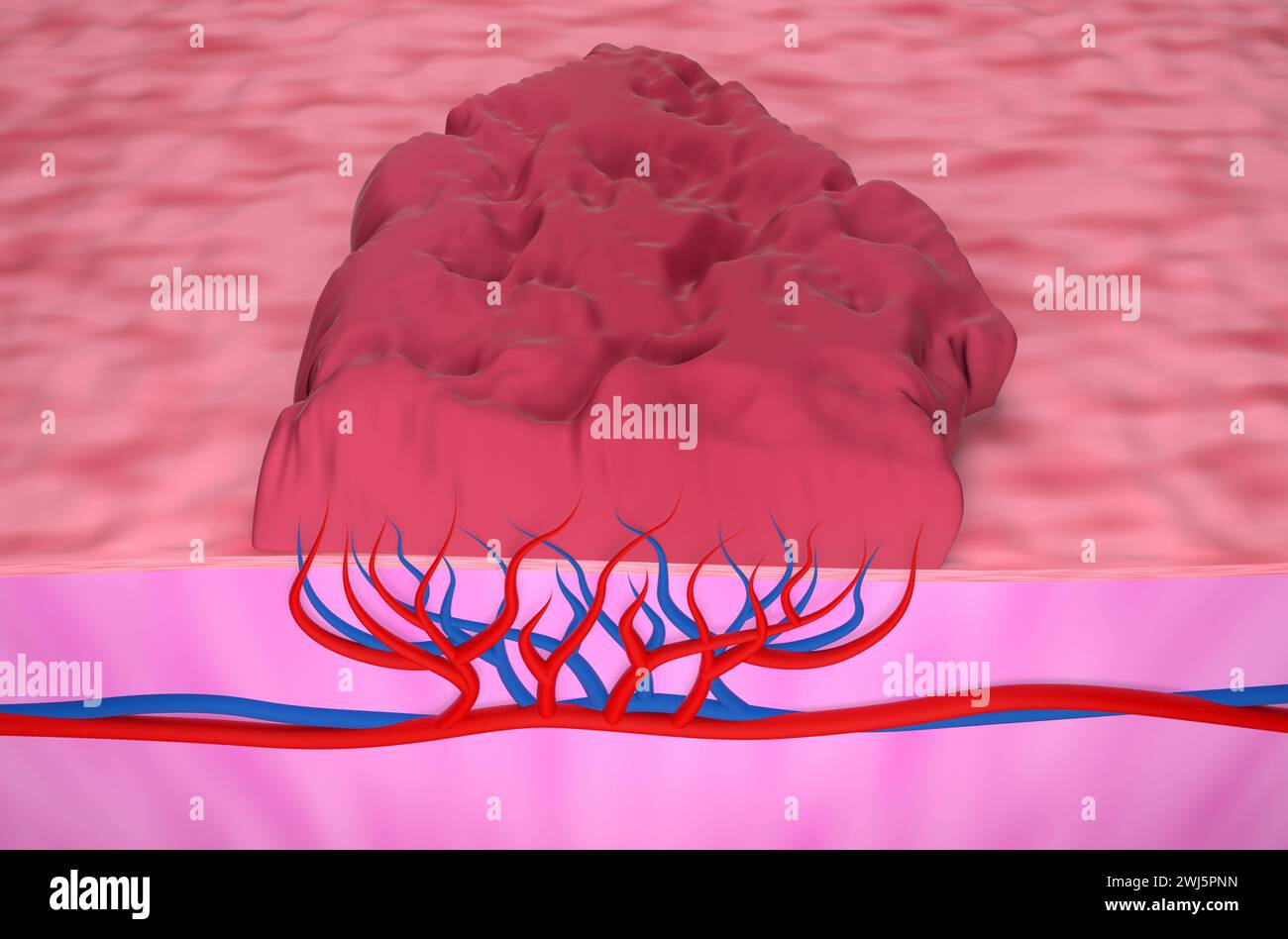 Hemangioma tumor - top view 3d illustration Stock Photo