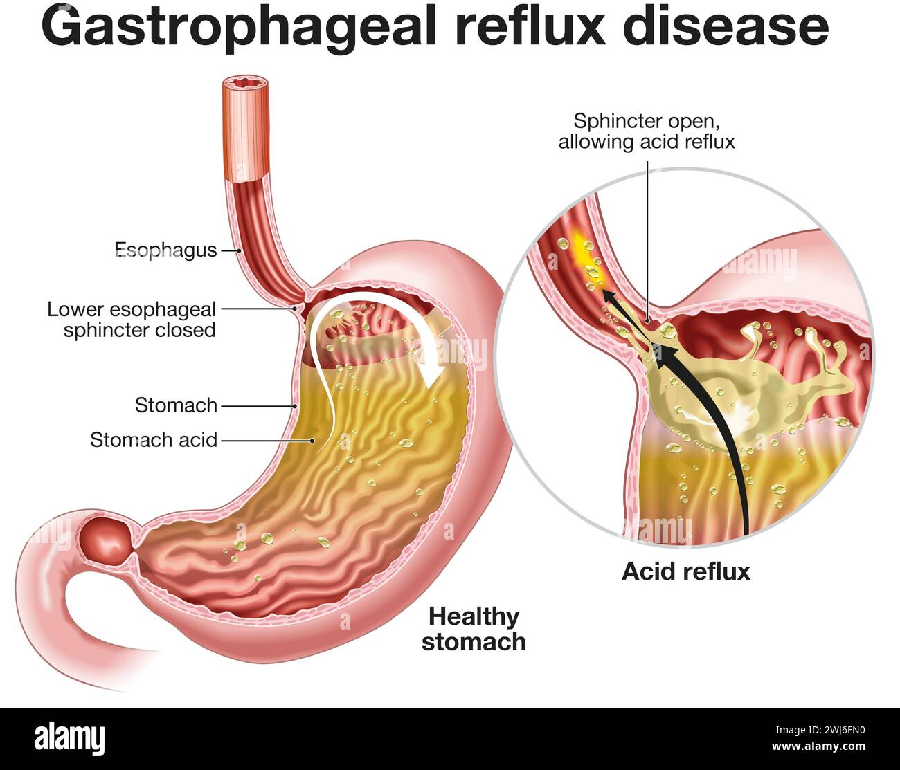 Illustration showing Gastrophageal reflux disease (GERD) is a digestive disorder where stomach acid flows back into the esophagus, causing discomfort Stock Photo
