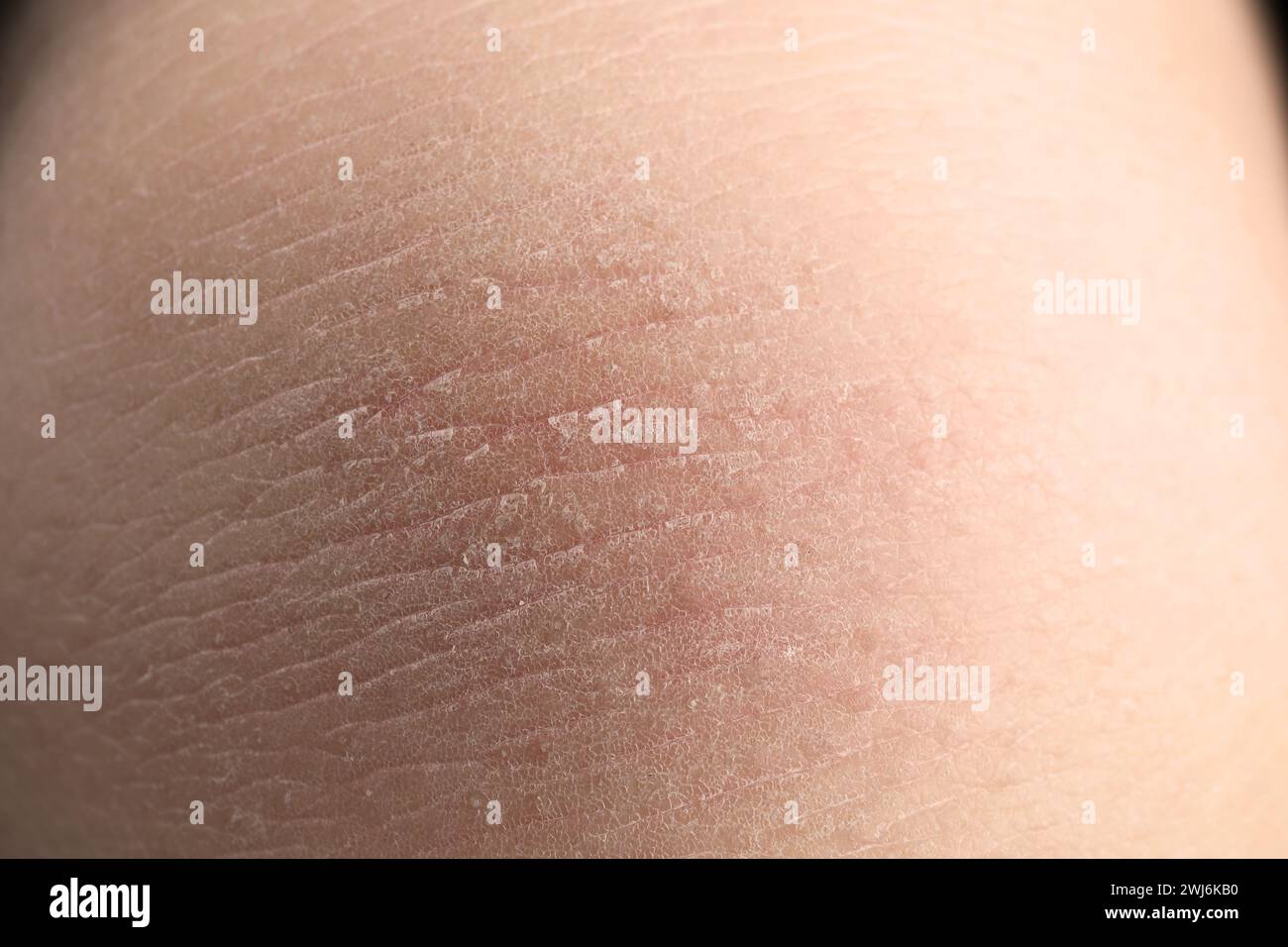Shedding skin human hi-res stock photography and images - Alamy