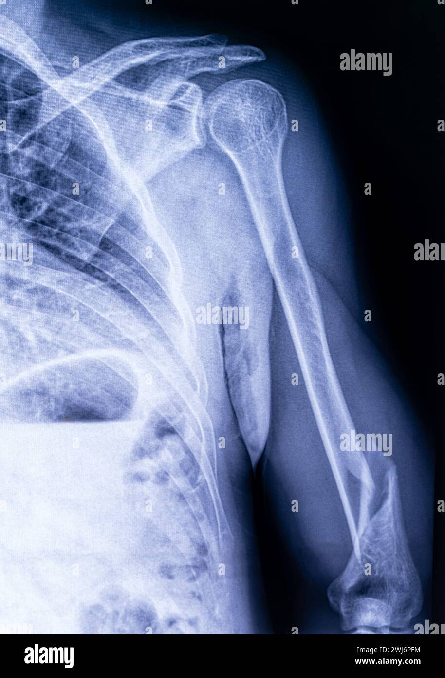 Close-up x-ray of a displaced humerus fracture in a man Stock Photo