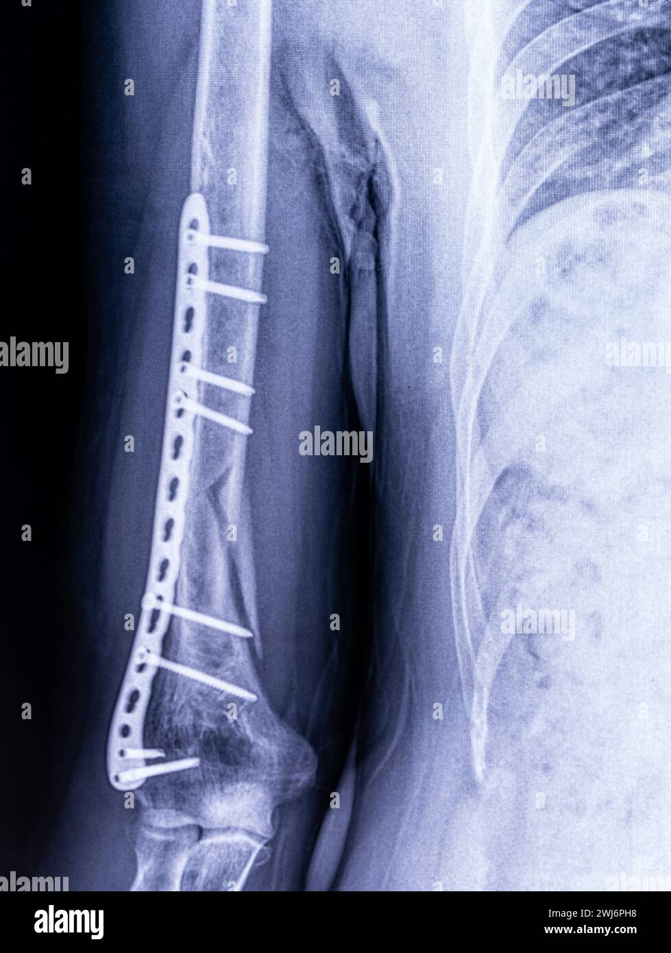 X-ray image of osteosynthesis of a humerus fracture in a man close-up Stock Photo
