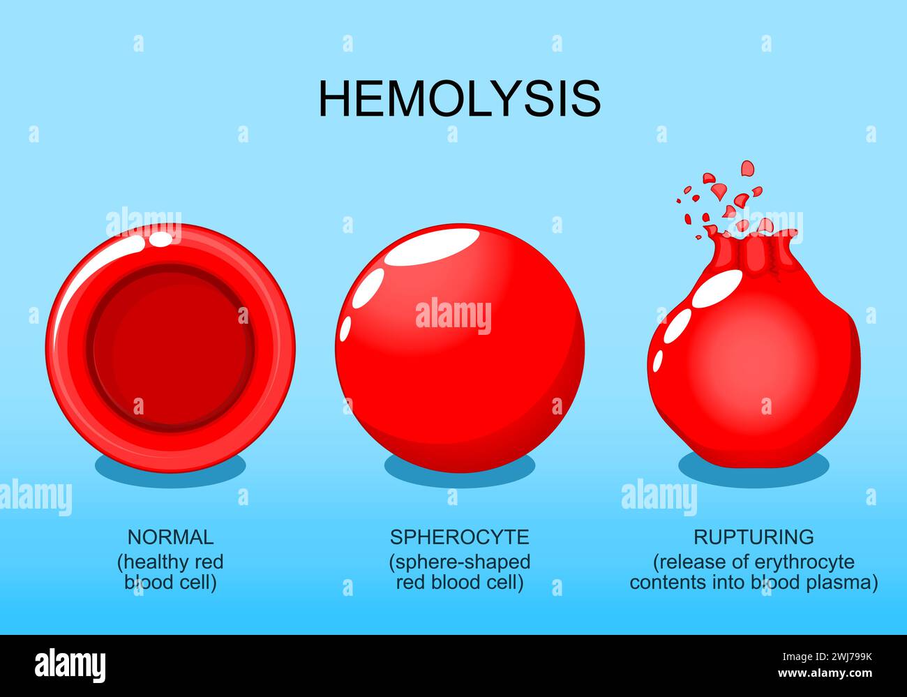 Hemolysis. Normal red blood cell, spherocyte, and rupturing of erythrocyte. Osmotic pressure. Vector poster. Isometric Flat illustration. Stock Vector