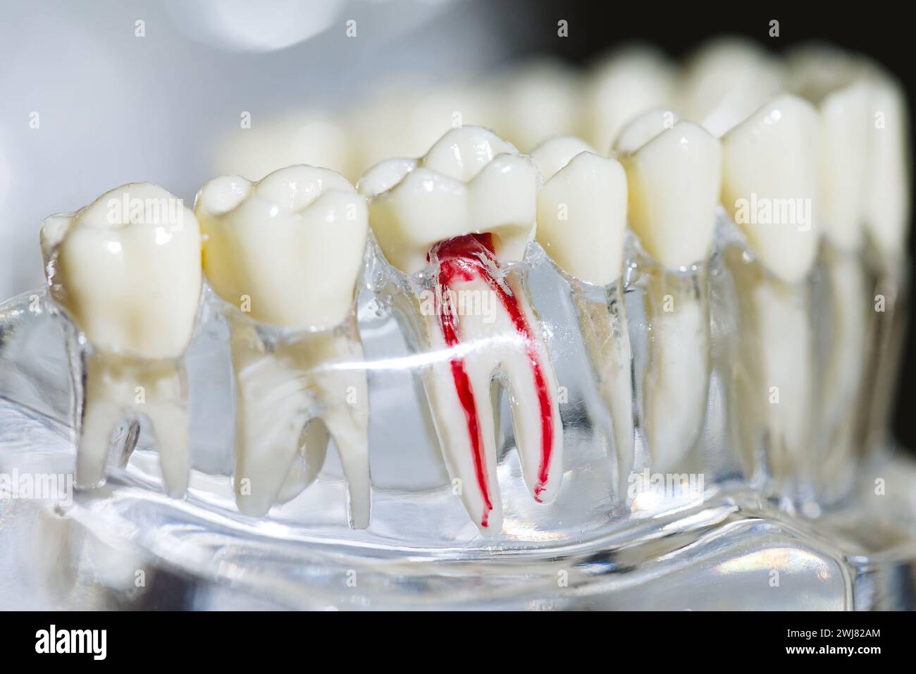 Dental implant, artificial tooth roots into jaw, root canal of dental ...