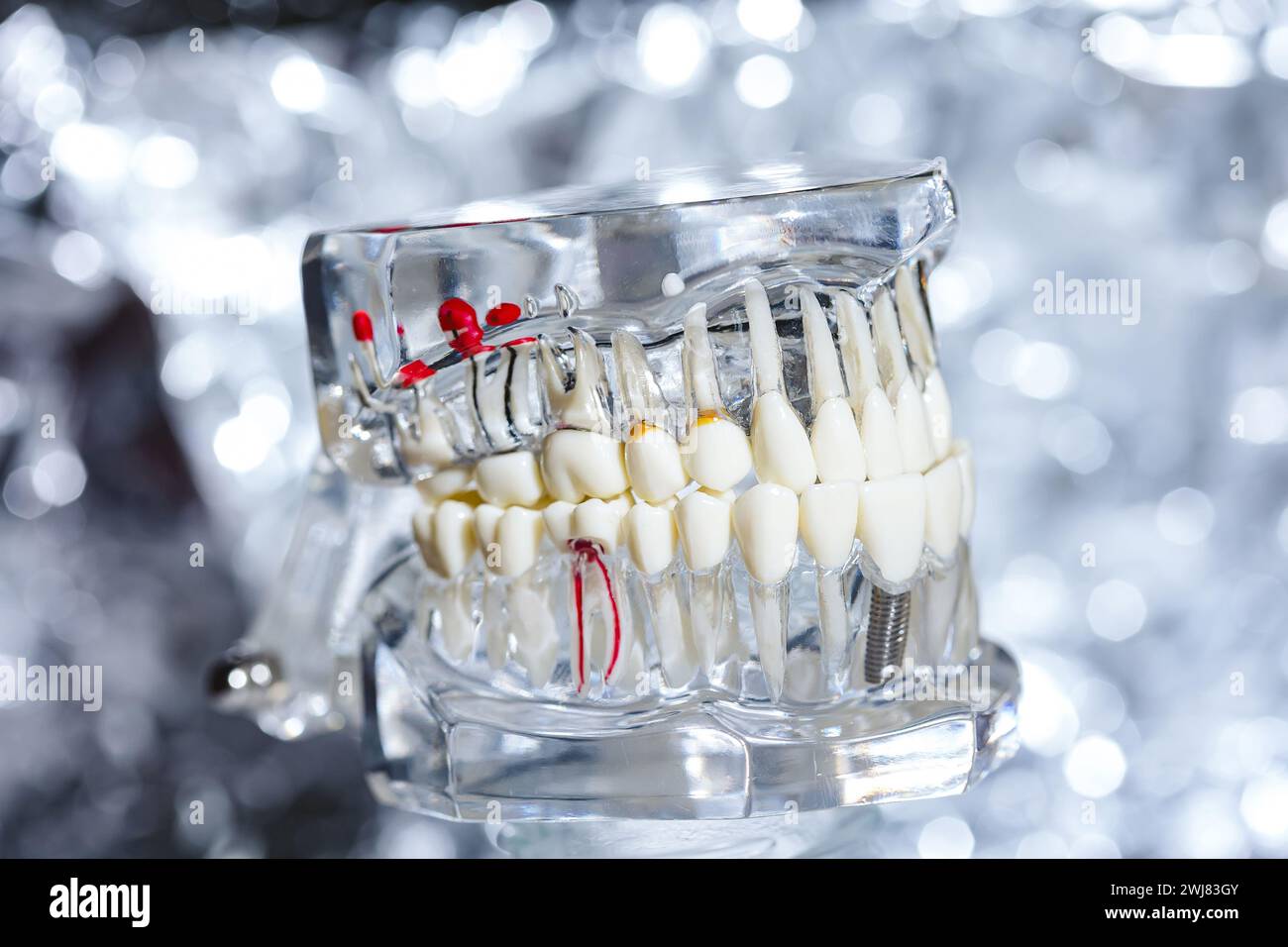 Dental tooth implant titanium prosthetic dentists model. Shallow dof ...