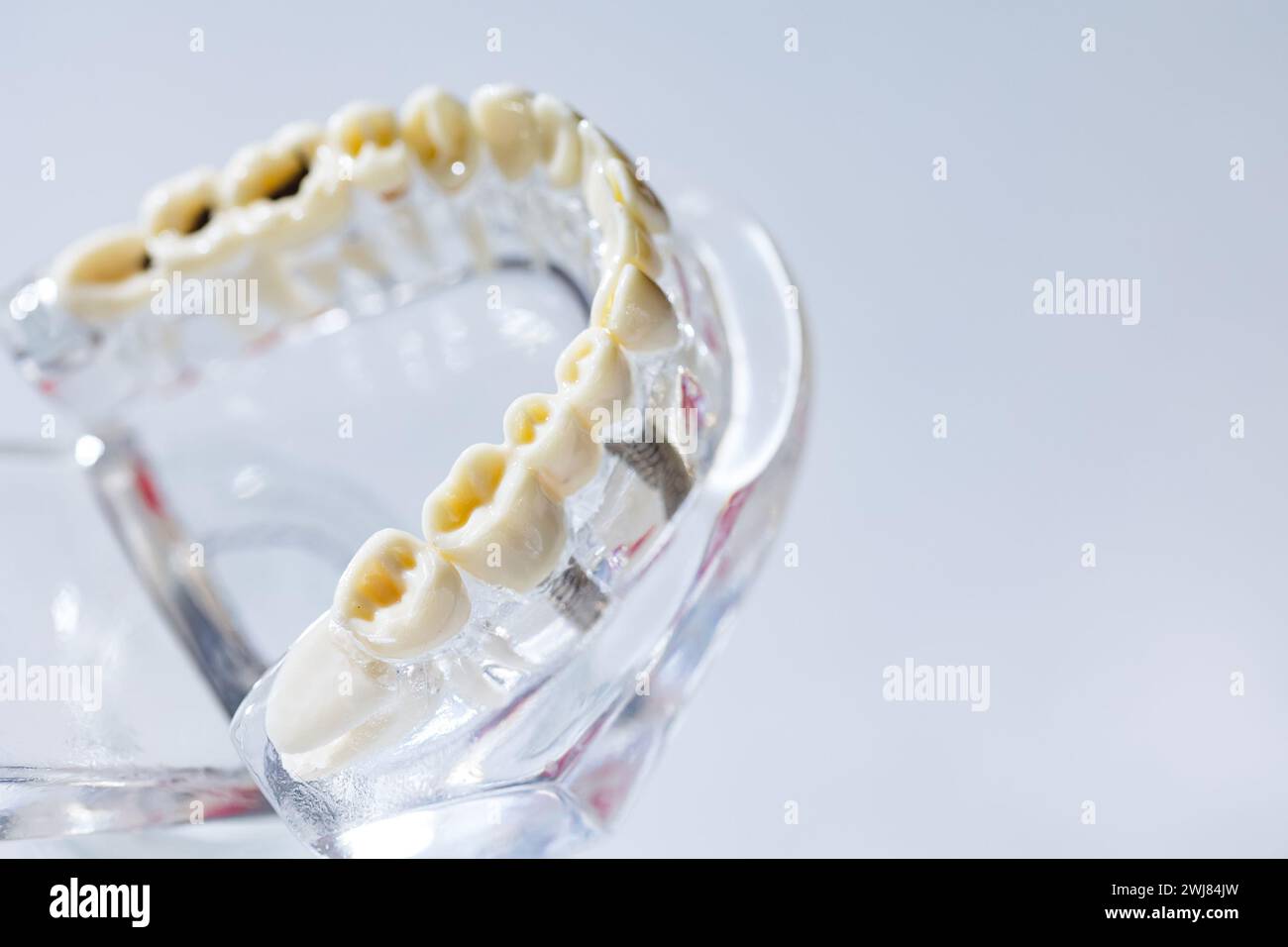 Caries tooth model, oral care concept. Dental model present common ...