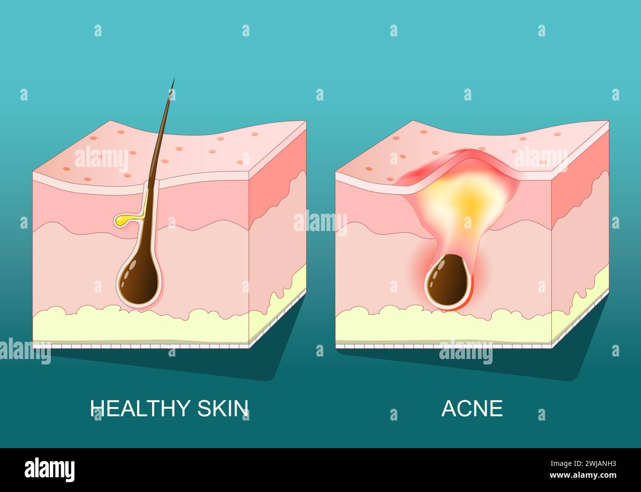 Acne. Cross section of a human skin with pimple, redness and inflammation. Vector poster. Isometric Flat illustration. Stock Vector