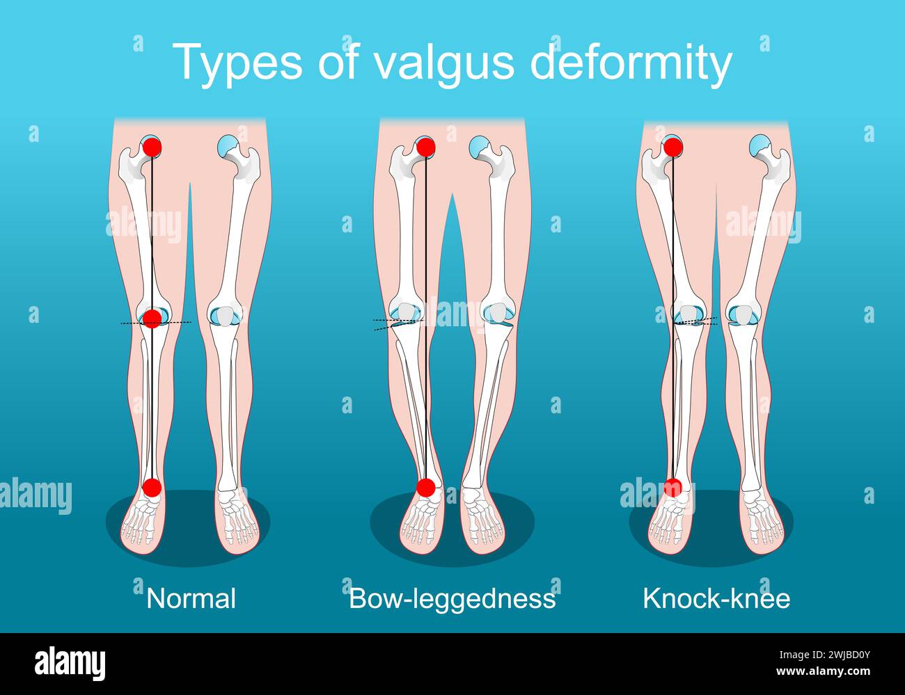 valgus deformities. Knee deformity. healthy joint, knock-knee and Bow-leggedness. Human legs, bones and joints. Corrective surgery. Vector poster. Iso Stock Vector