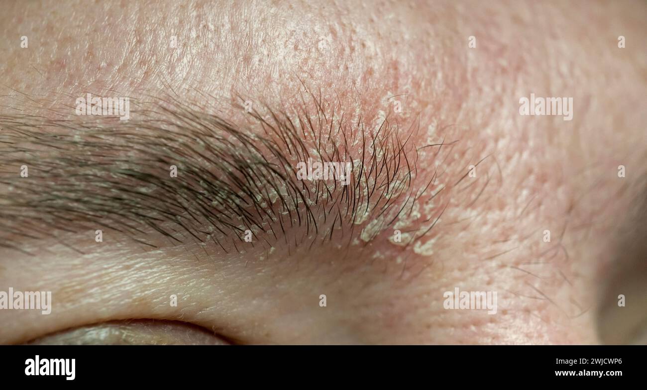 Eczema On Eyelids And Eyebrows At Norris Carrico Blog