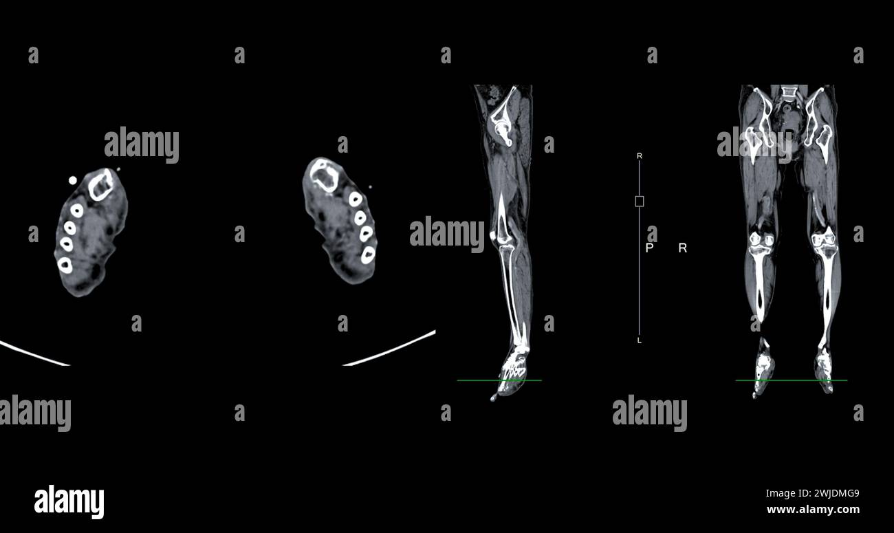 A CT venogram of the leg is a non-invasive imaging procedure offering detailed visuals of leg veins. Stock Photo