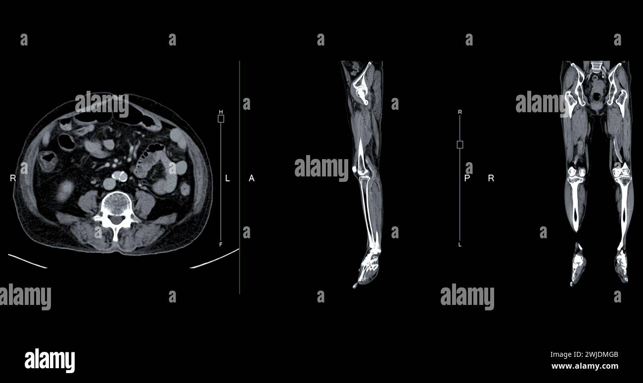 A CT venogram of the leg is a non-invasive imaging procedure offering detailed visuals of leg veins. Stock Photo