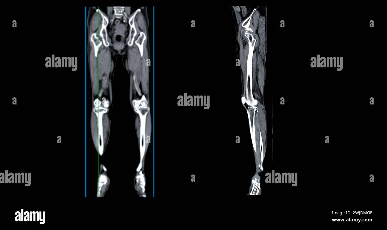 A CT venogram of the leg is a non-invasive imaging procedure offering detailed visuals of leg veins. Stock Photo