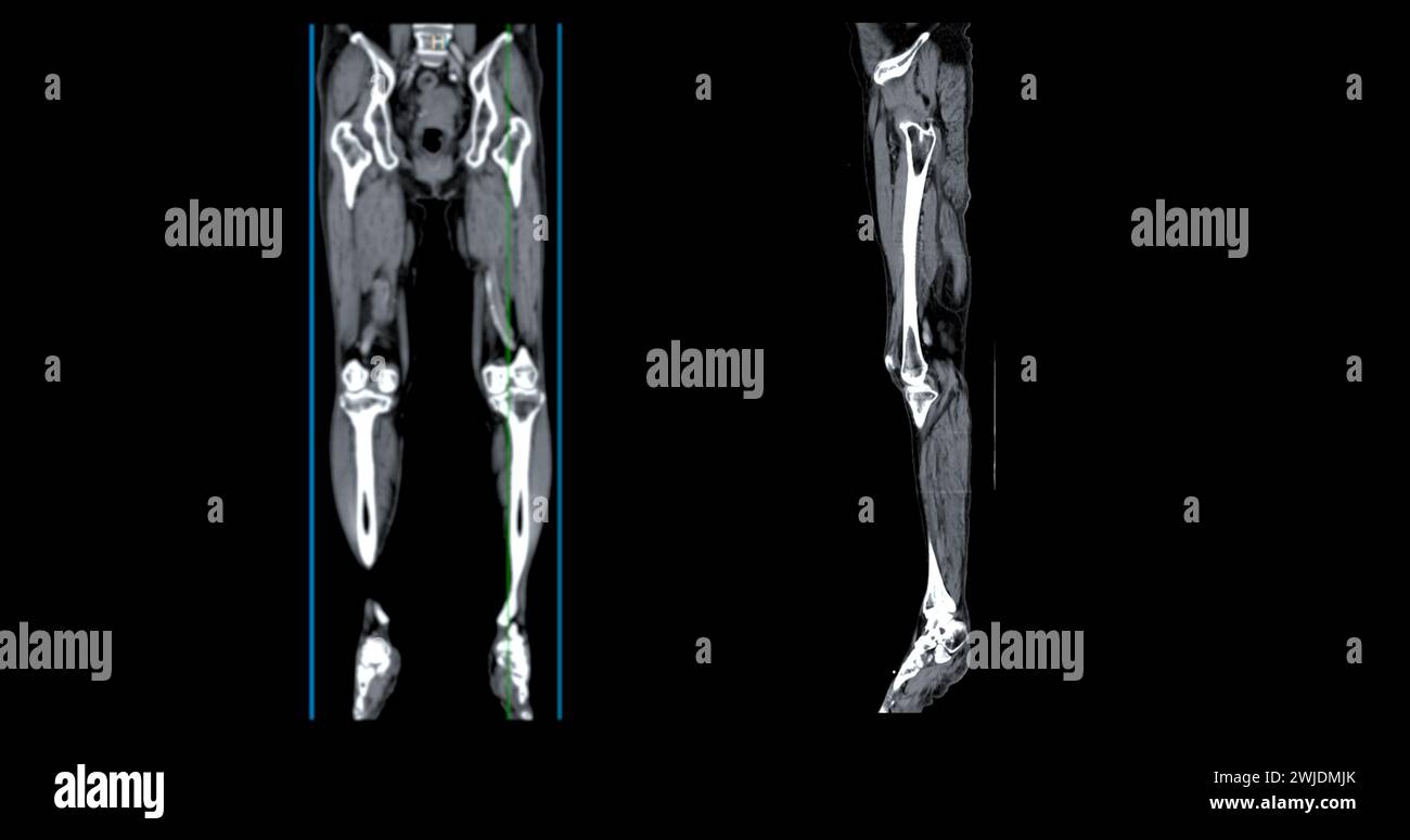 A CT venogram of the leg is a non-invasive imaging procedure offering detailed visuals of leg veins. Stock Photo