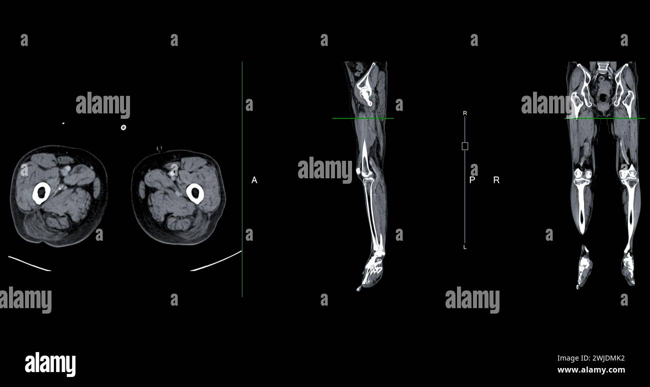 A CT venogram of the leg is a non-invasive imaging procedure offering detailed visuals of leg veins. Stock Photo