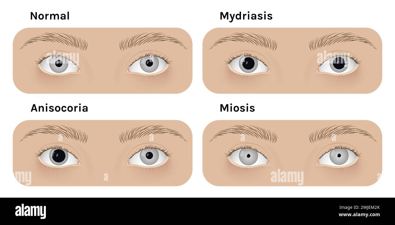 Realistic human normal eyes and with mydriasis, anisocoria, miosis