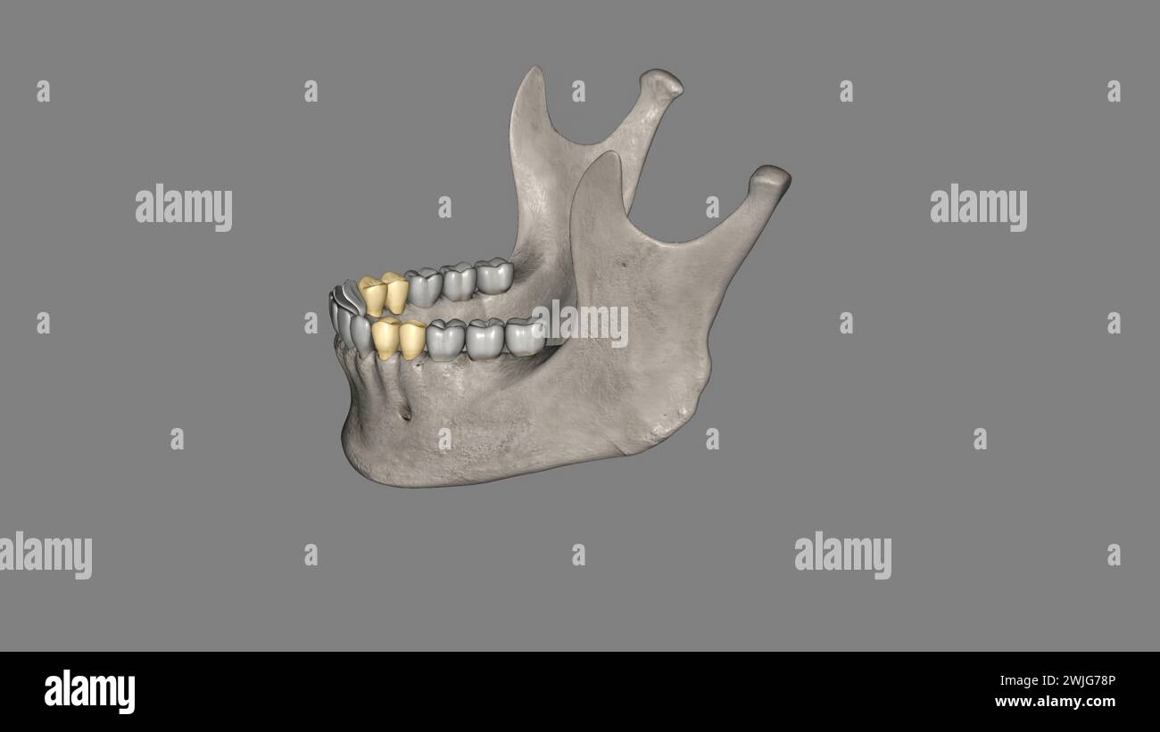 The mandibular first premolar is the tooth located laterally from both ...