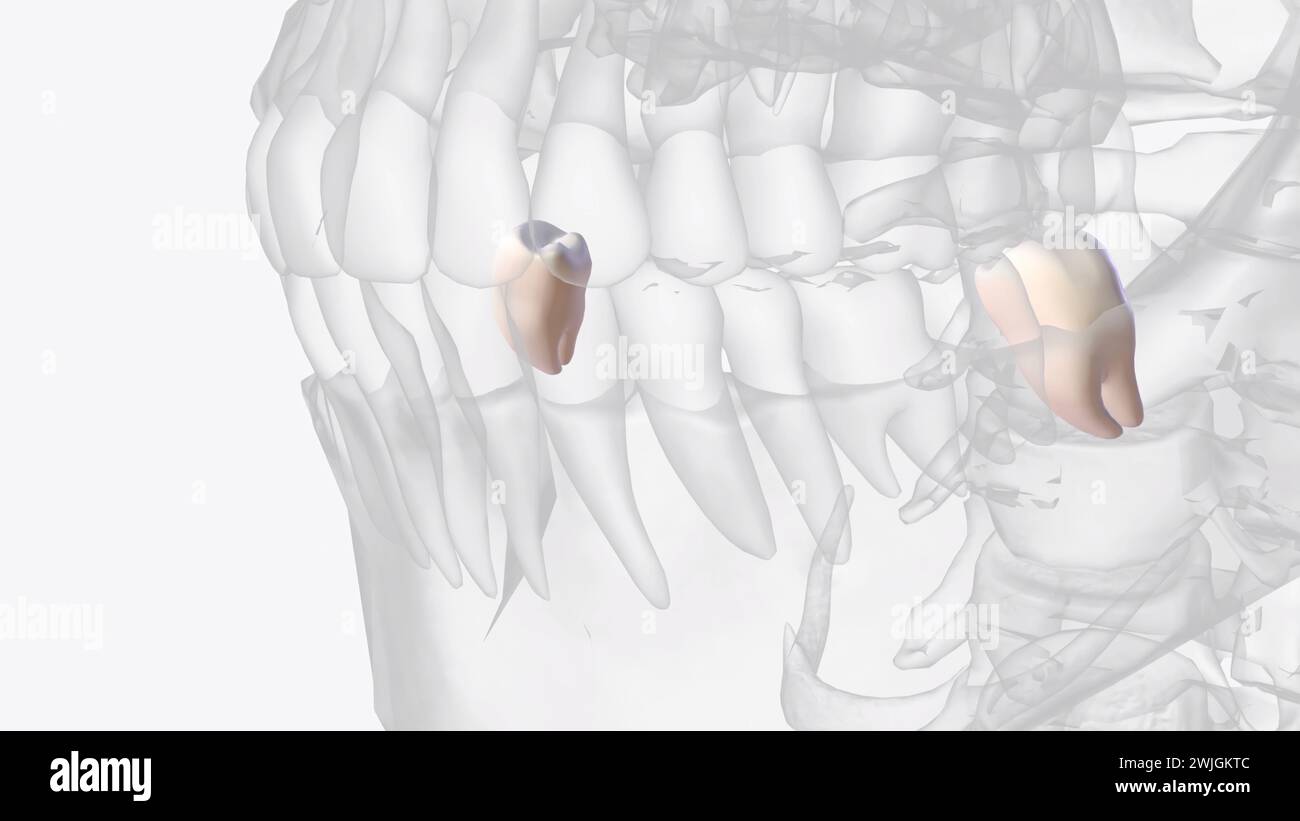 Mandibular third molars usually have two roots: mesial and distal as on ...