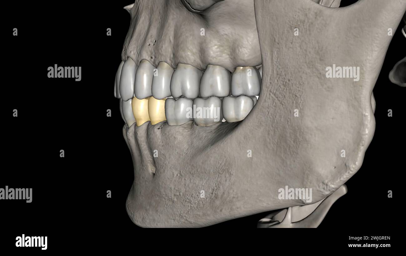 The mandibular first premolar is the tooth located laterally from both ...