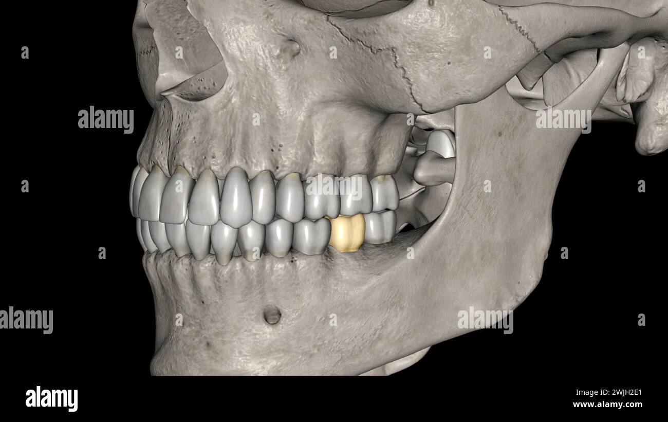 The mandibular second molar resembles the mandibular first permanent ...