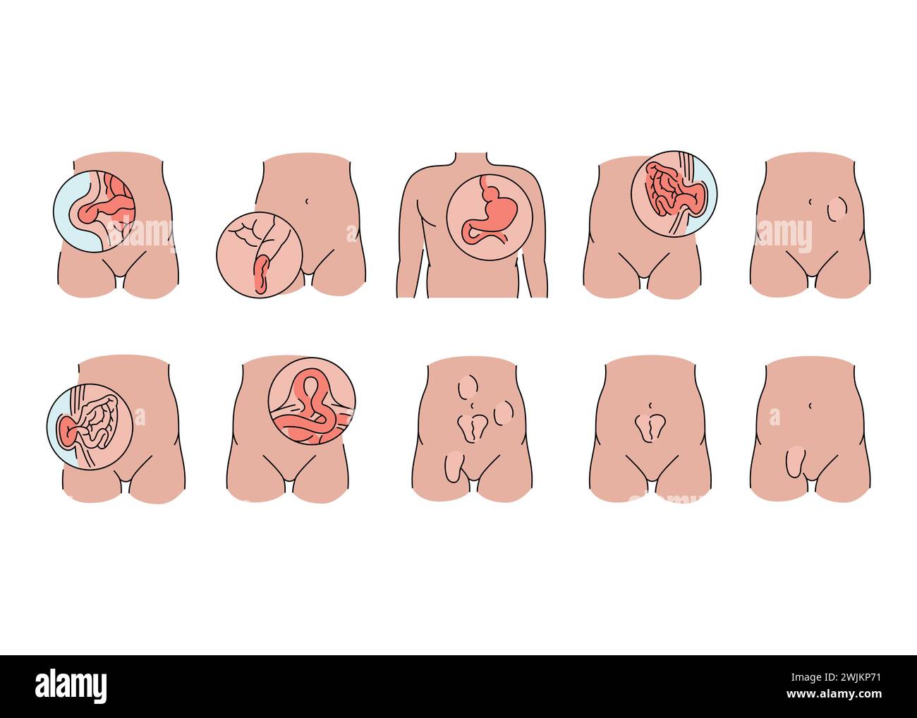Hernias line icons set. Vector isolated element. Editable stroke. Stock Vector