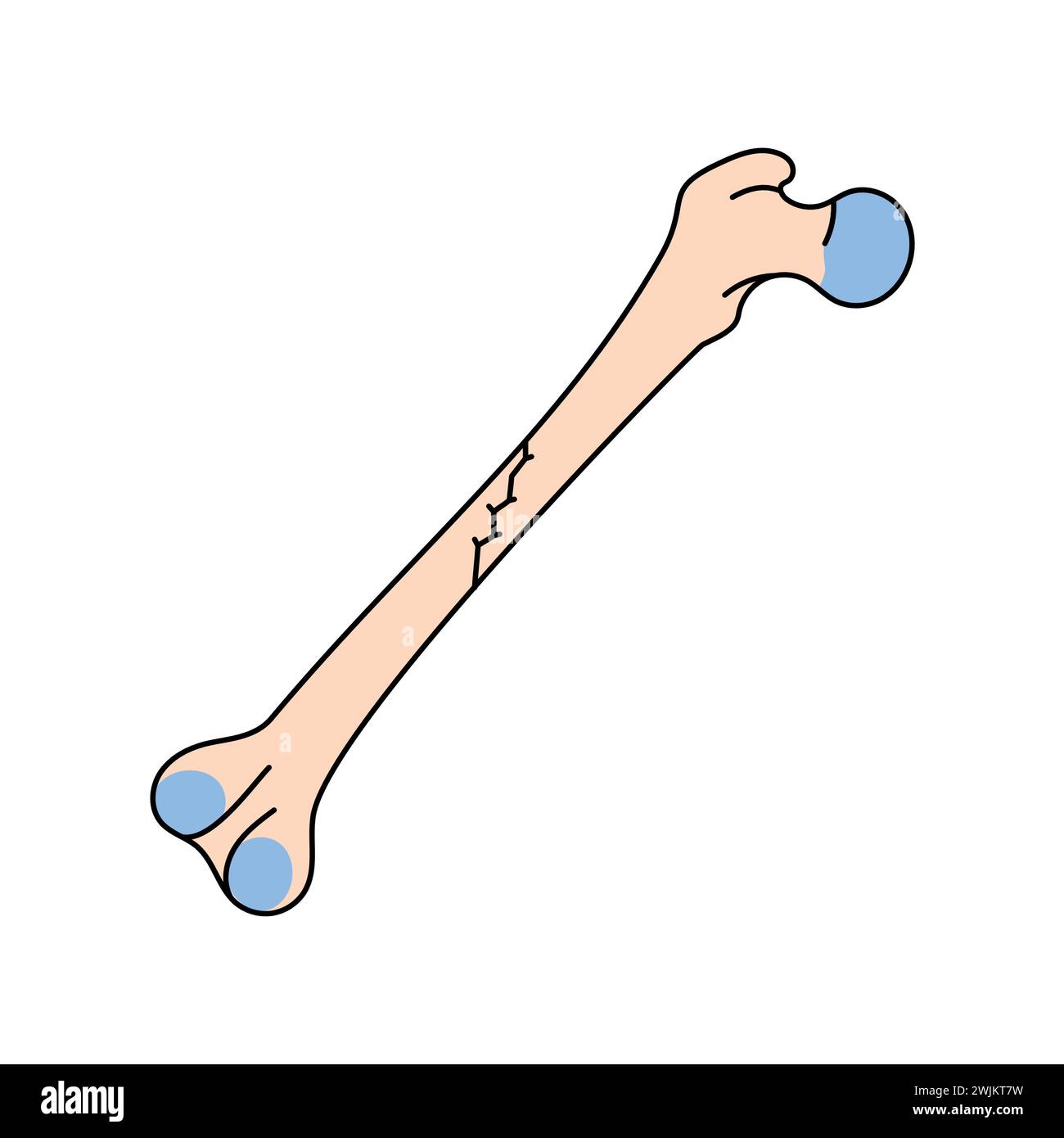 Oblique nondisplaced bone fracture line icon. Vector isolated element. Editable stroke. Stock Vector