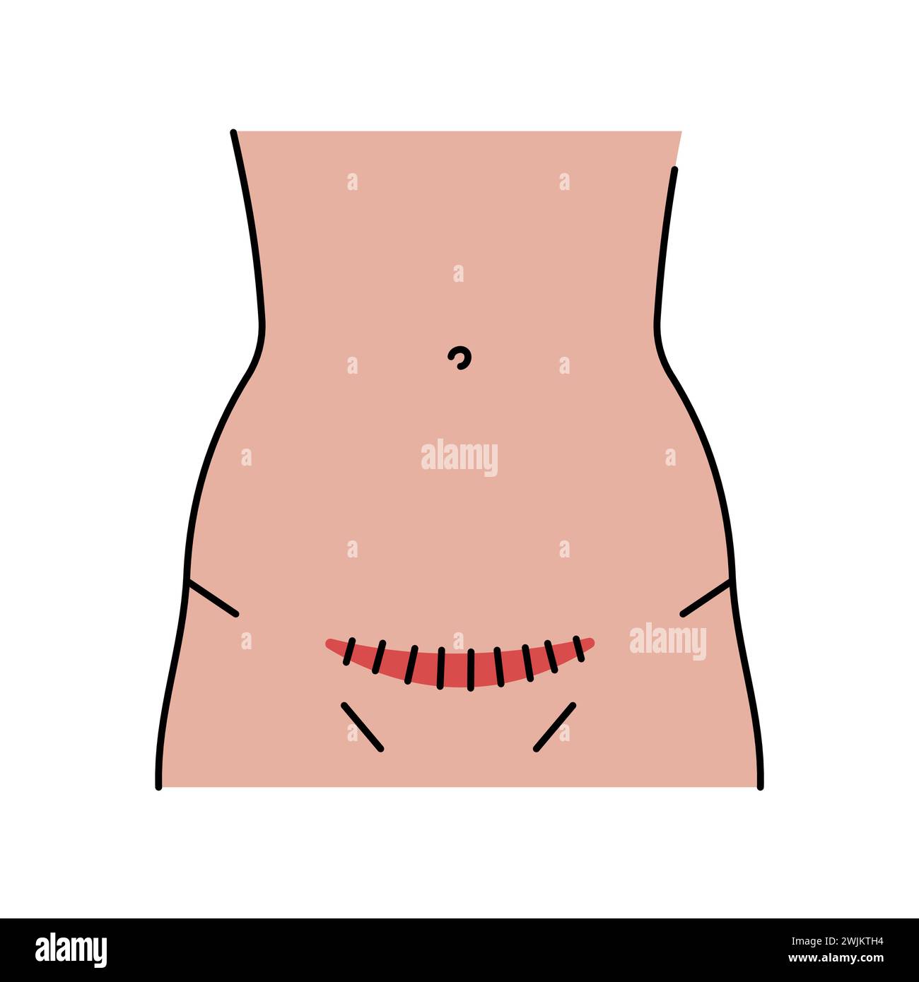 Pfannenstiel incision line icon. Abdominal incisions. Vector isolated ...