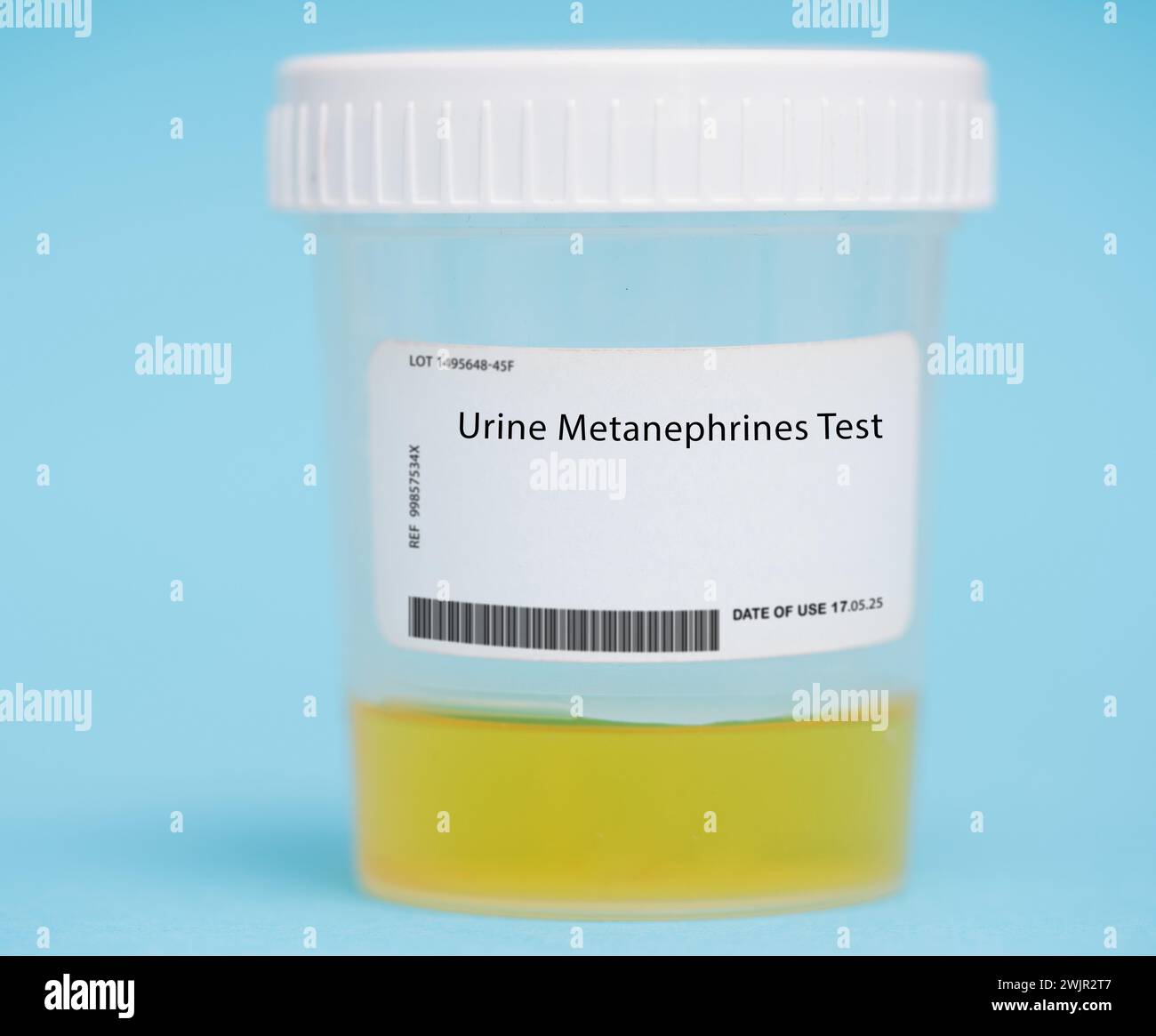 Urine metanephrines test. This test measures the levels of