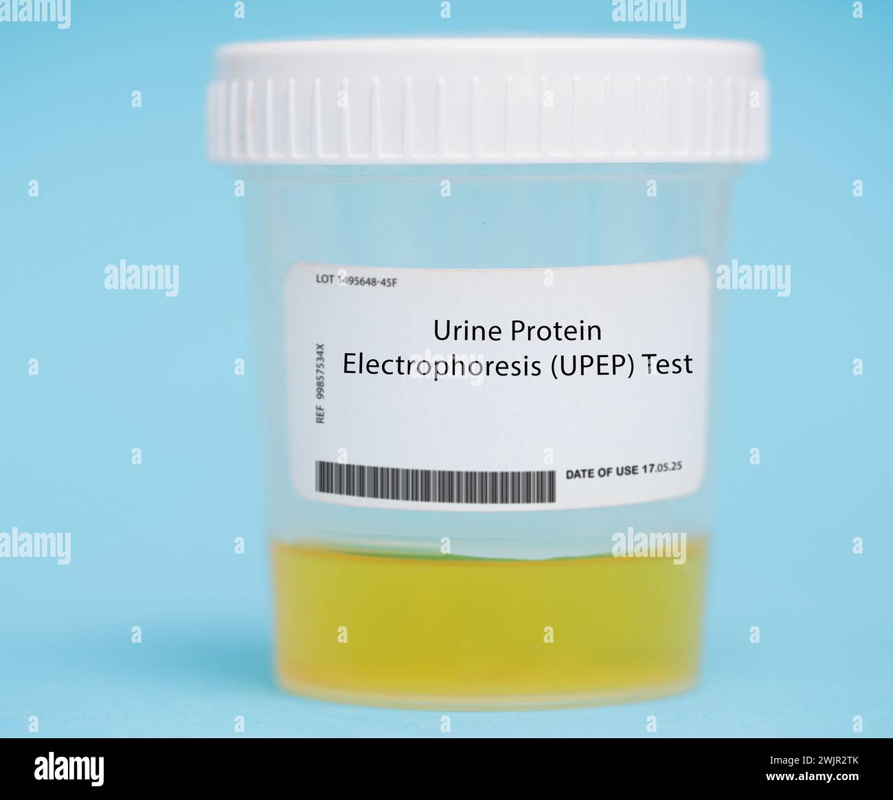 Urine protein electrophoresis (UPEP) test. This test separates and