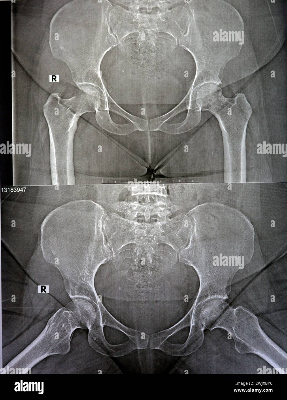 Plain X ray reveals bilateral Avascular necrosis (AVN) of the femoral head more in the left side, a type of aseptic osteonecrosis, which is caused dis Stock Photo