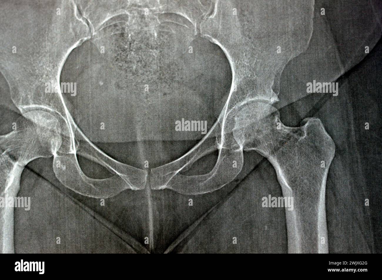 Plain X ray reveals bilateral Avascular necrosis (AVN) of the femoral head more in the left side, a type of aseptic osteonecrosis, which is caused dis Stock Photo