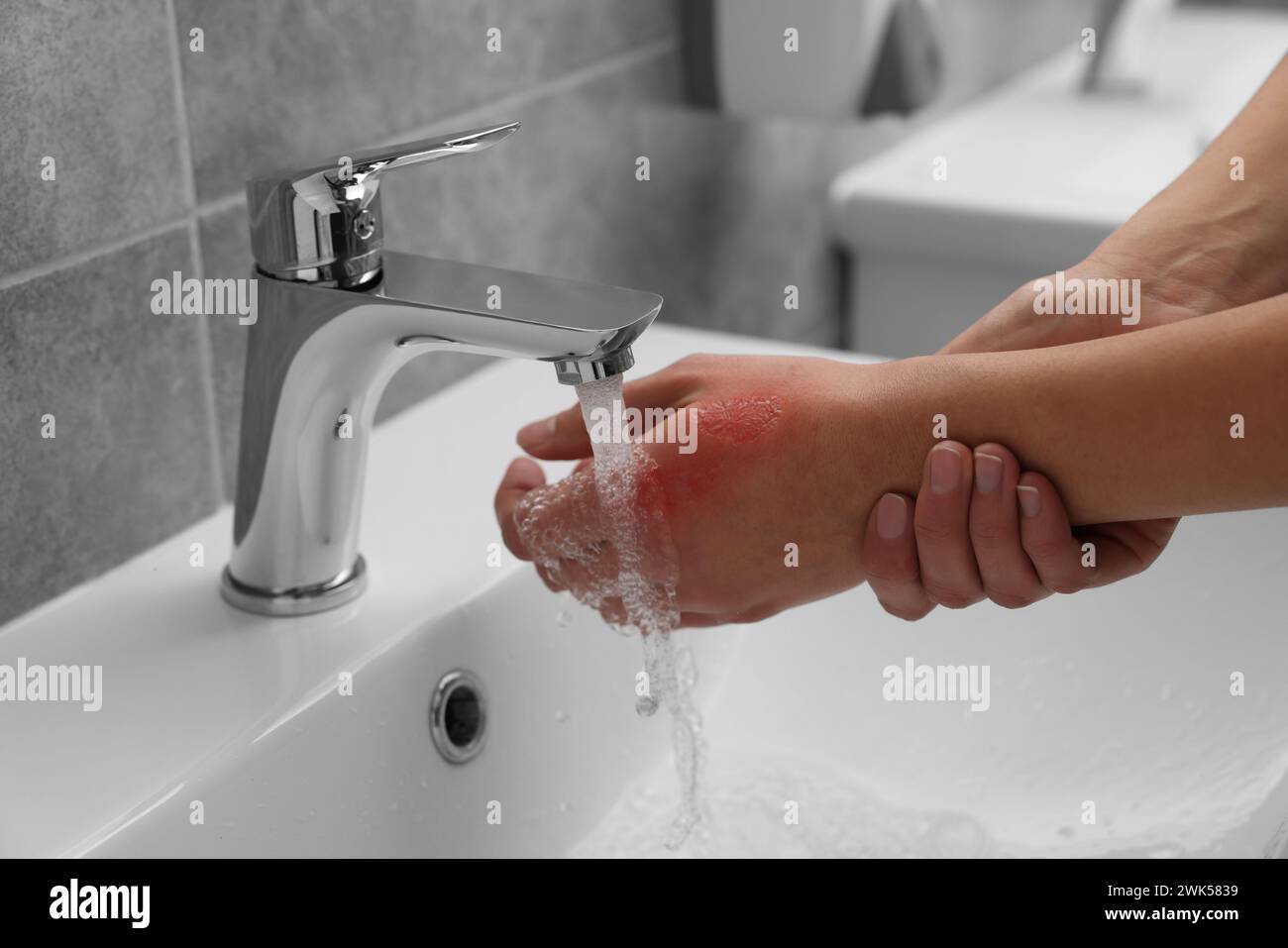 Burn skin cold water hires stock photography and images Alamy