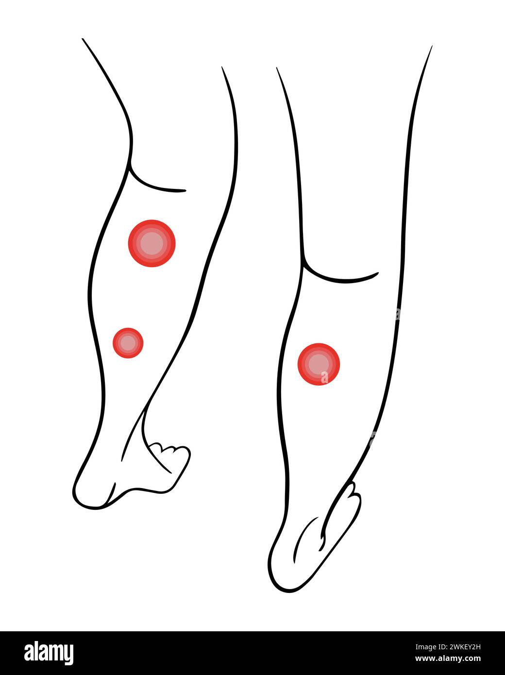 Varicose veins of the legs. Treatment of varicose veins. Stock Vector