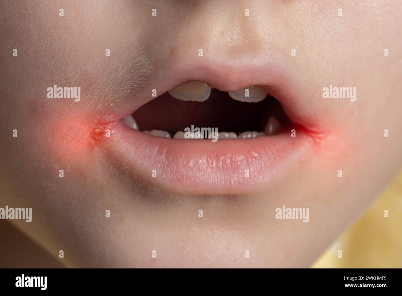 slitlike impetigo in a little girl in the corners of her mouth. Skin