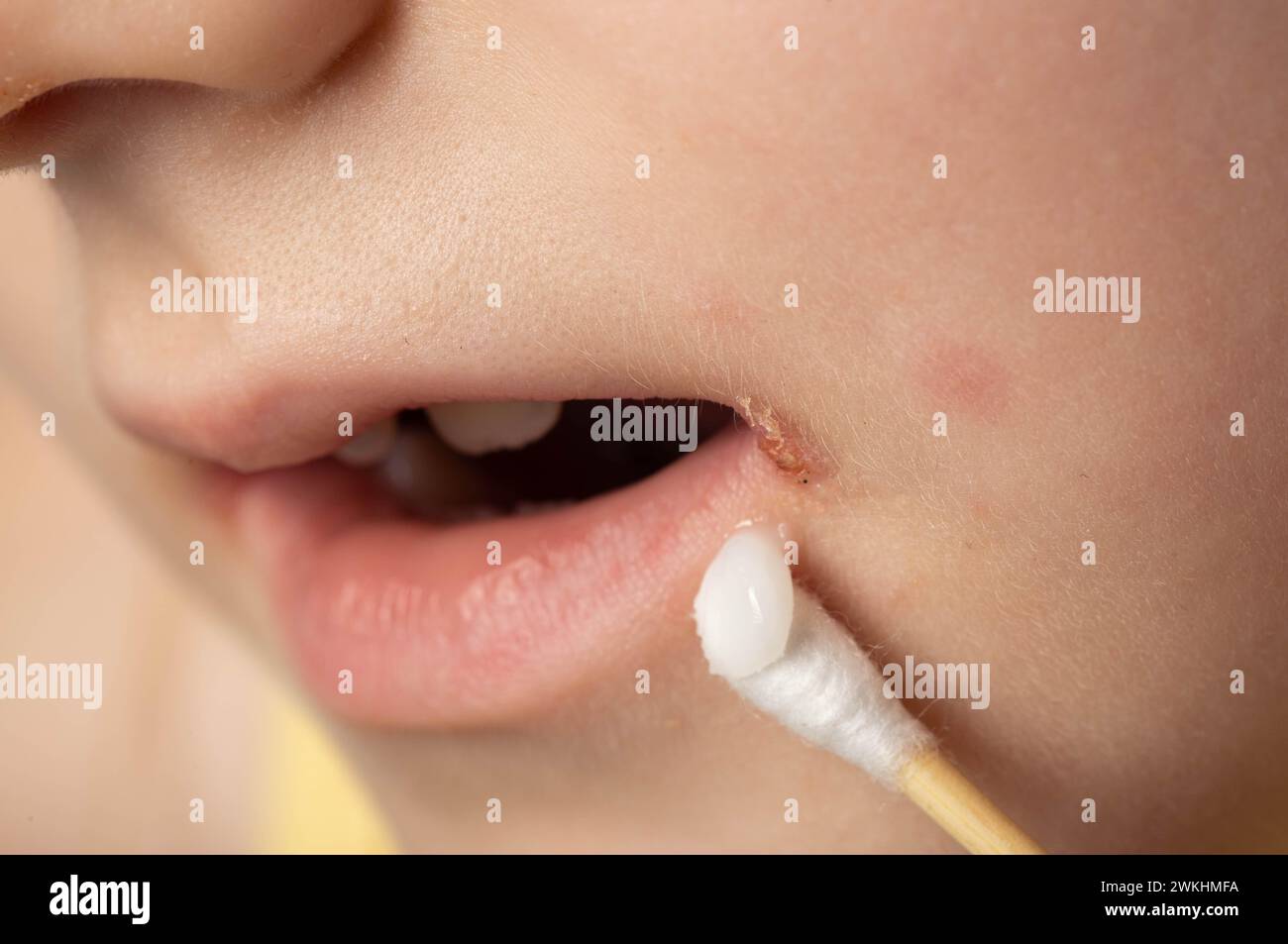 Treatment with ointment for a dermatological disease in the corners of