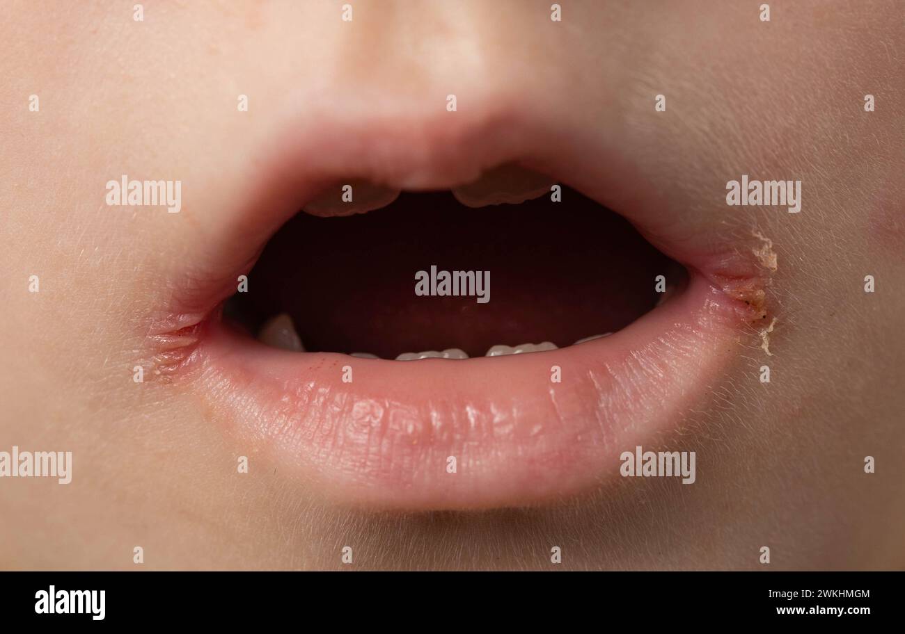 slitlike impetigo in a little girl in the corners of her mouth. Skin
