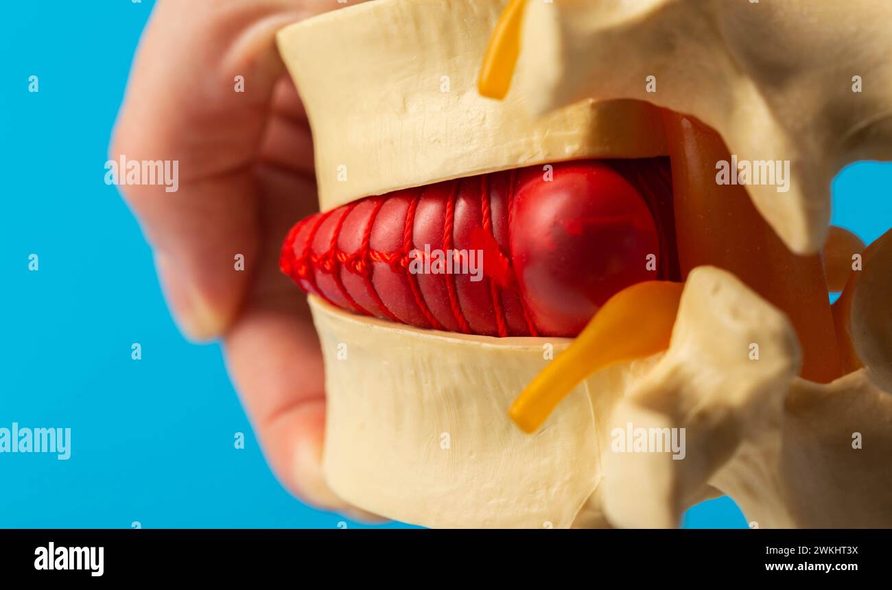 Convex red intervertebral disc herniation on a model of the spine. Treatment of problems and diseases of the spine. Orthopedics and vertebrology. Stock Photo