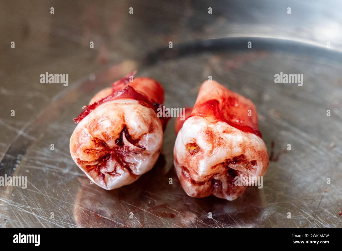 Freshly extracted molar wisdom teeth with blood stain with focus on