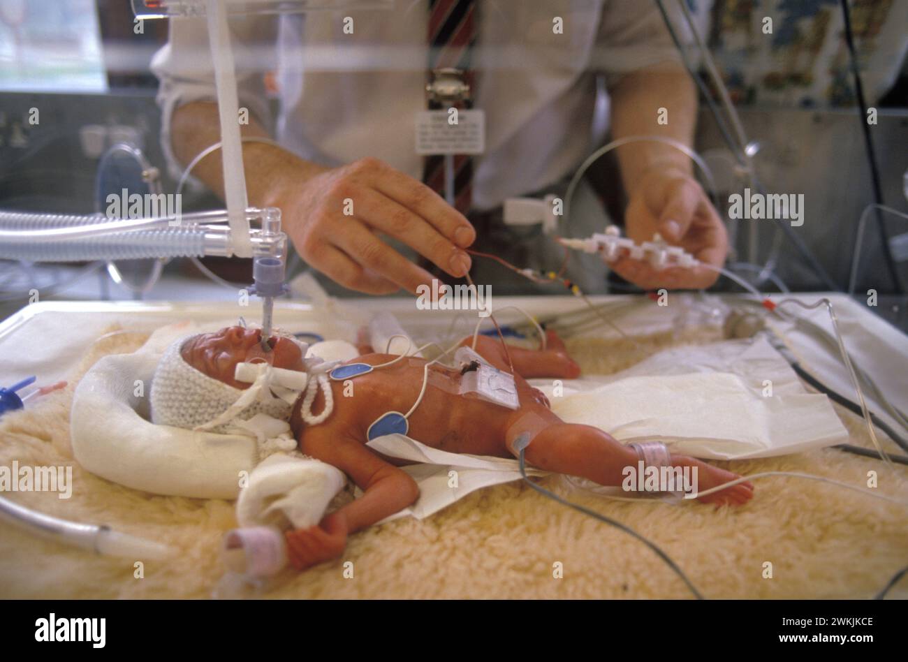 NHS 1980s Low birth weight Premature baby in special care unit