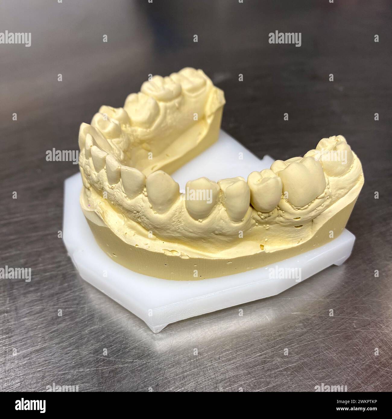 photo of the lower jaw, a plaster impression of the jaw on a metallic