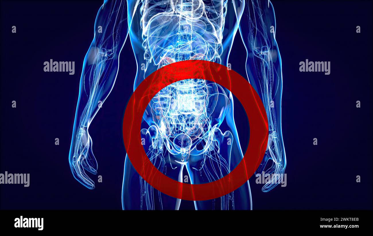 Abstract illustration of the colon cancer Stock Photo