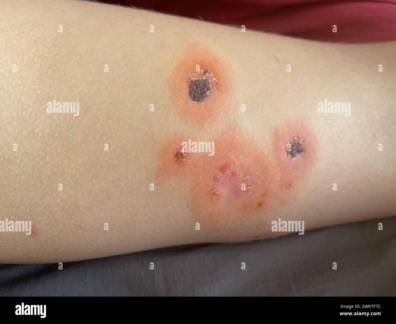 Human shin leg closeup. Body with skin problem. Infectious disease ...