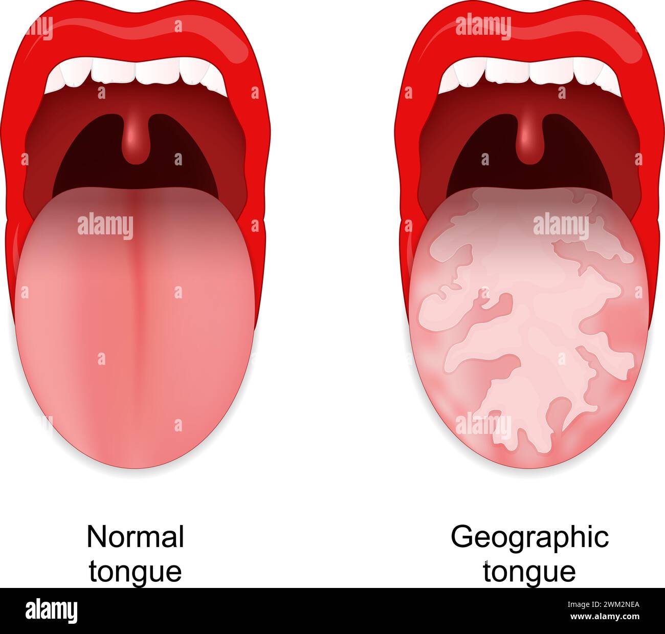 Geographic tongue. Benign migratory glossitis. Oral cavity anomalies. Vector illustration Stock Vector