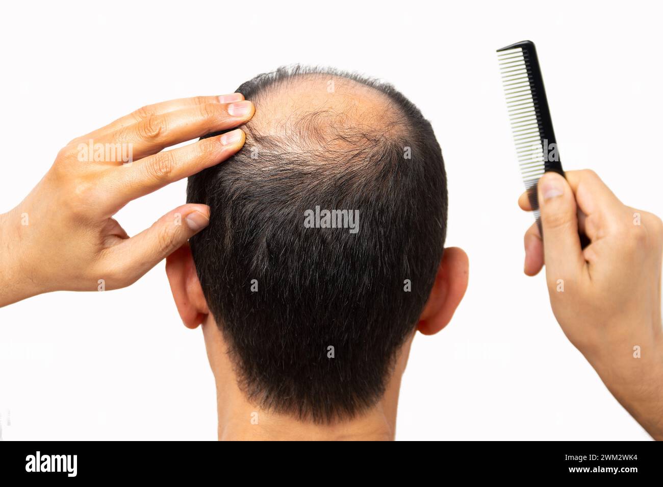 'balding, man concerned about his hair' Stock Photo