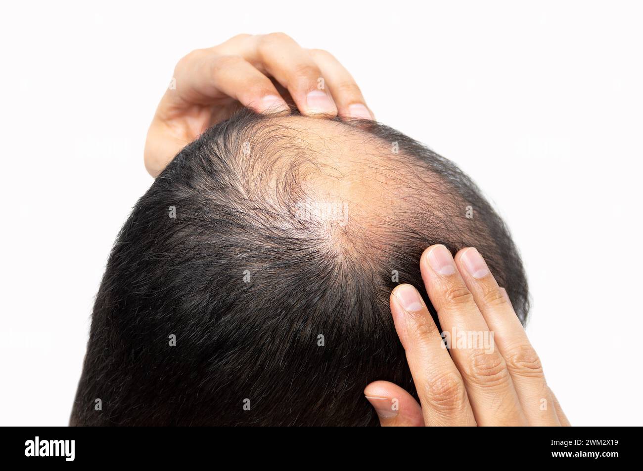 Middle-aged man concerned with hair loss. Baldness Stock Photo