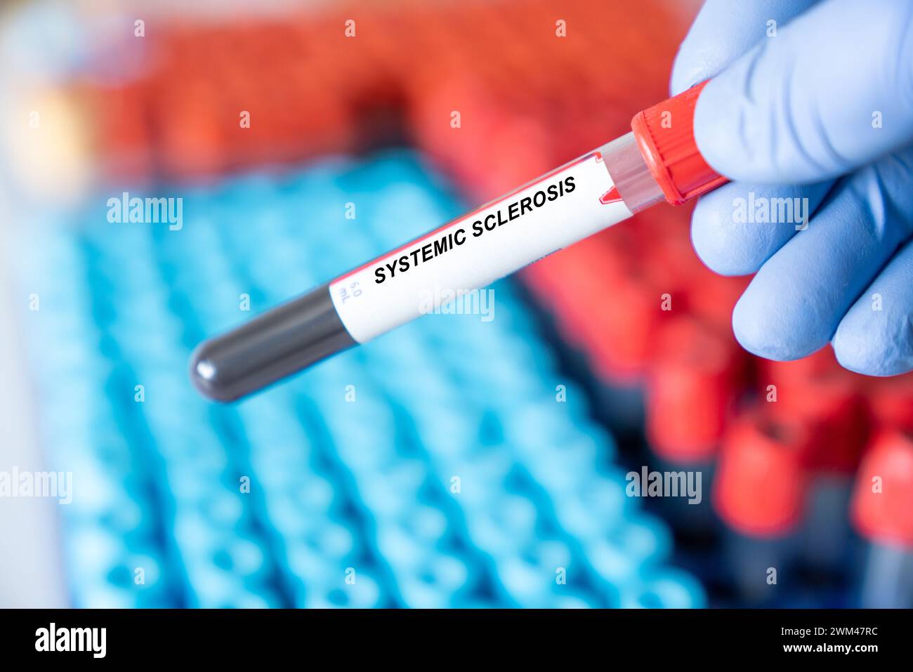 Systemic sclerosis blood test Stock Photo