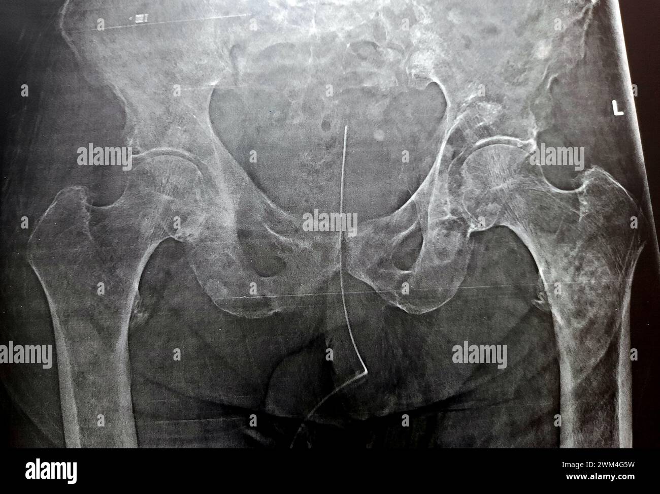 High probability of subtrochanteric, trochanteric fissure fracture, and malignancy metastasis in medial side of the upper femur shaft, of an old patie Stock Photo