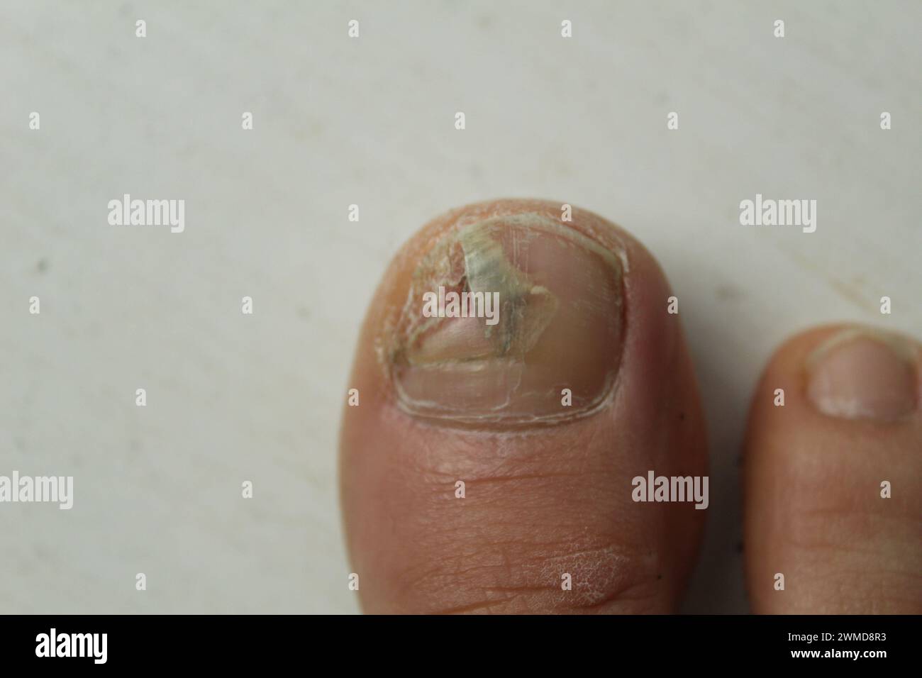 Fungal diseases of the nails and skin of the feet close-up. Podology and treatment options for nail plates. Nail destruction. Stock Photo