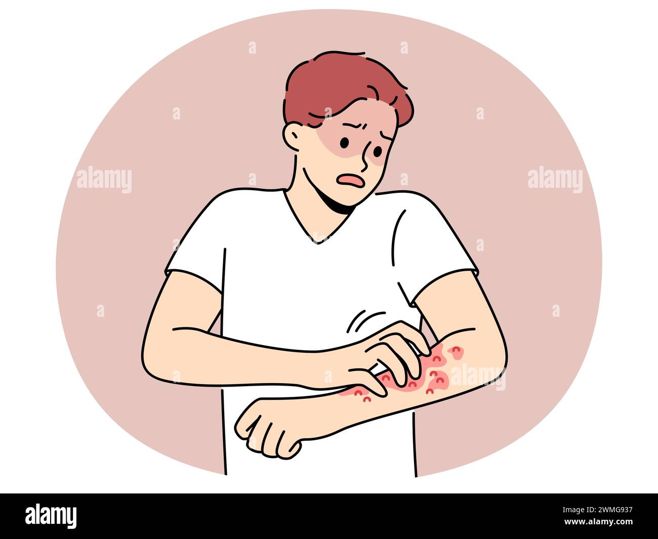 Unhealthy man scratch red pimples on arm suffer from allergy or dermatitis. Stressed unwell guy suffer from itchiness and redness. Healthcare. Vector illustration. Stock Vector