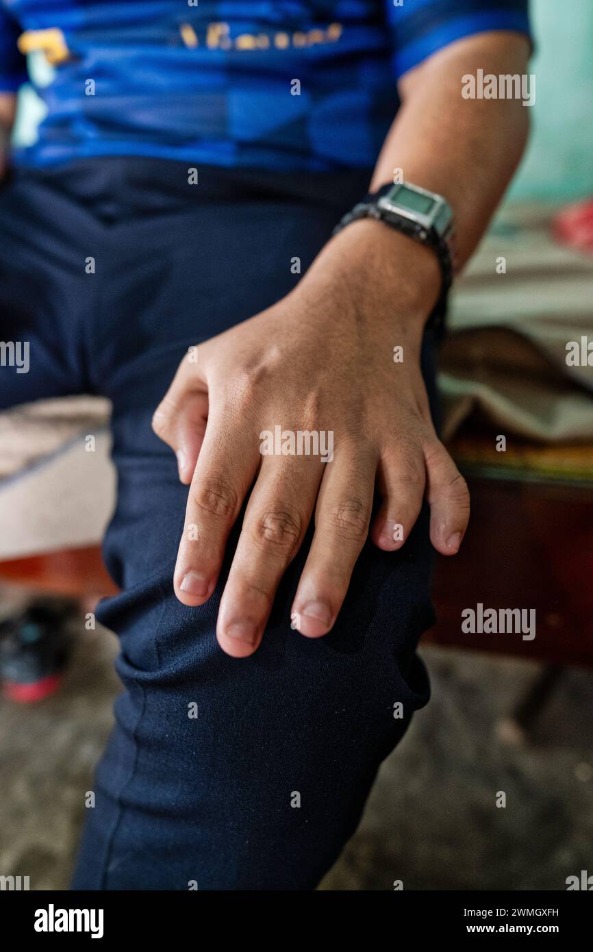 In Photos: The Devastation Of Agent Orange Four Decades After The Vietnam War