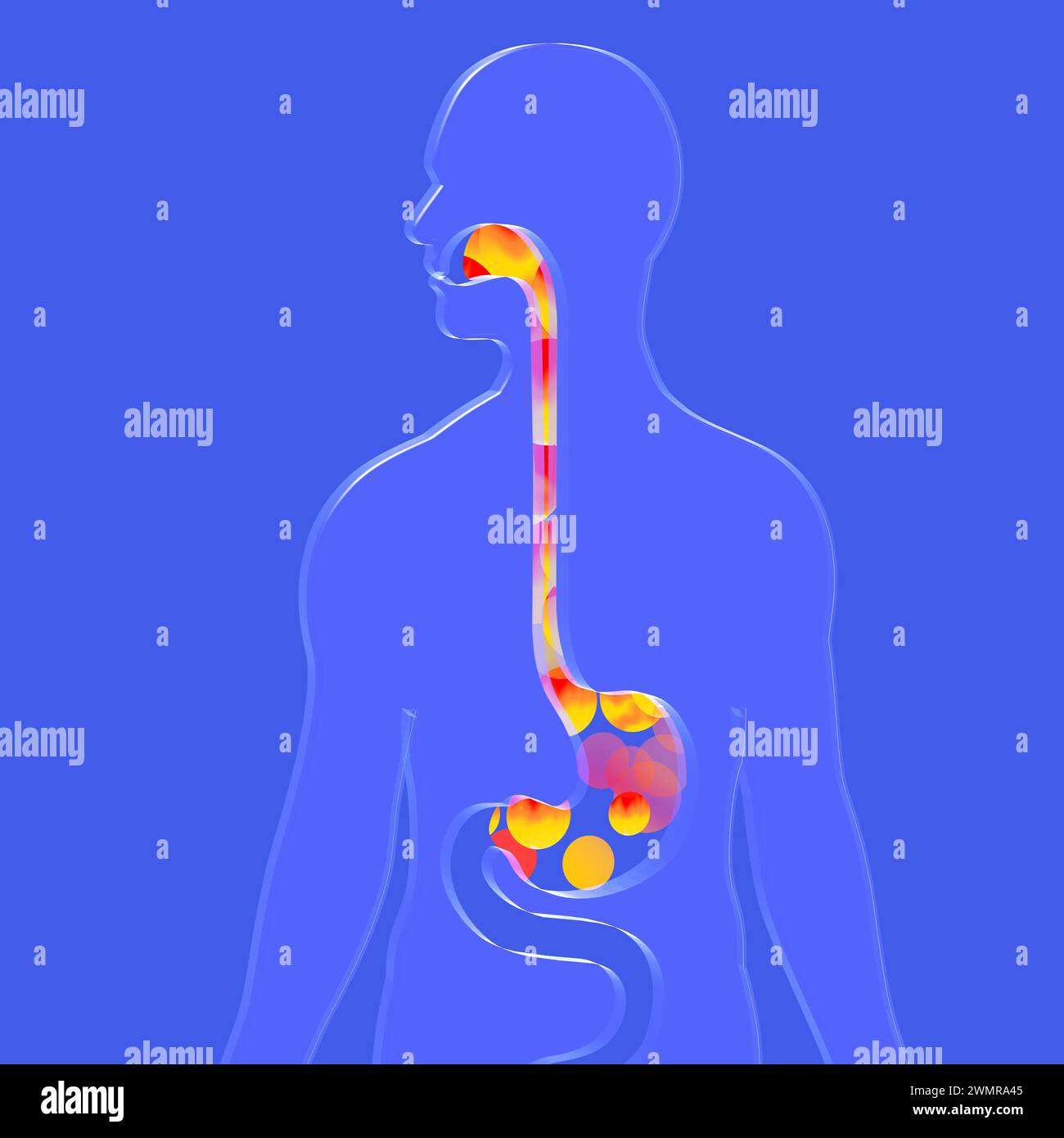 3d illustration of esophagus with gastric reflux and heartburn. With ...