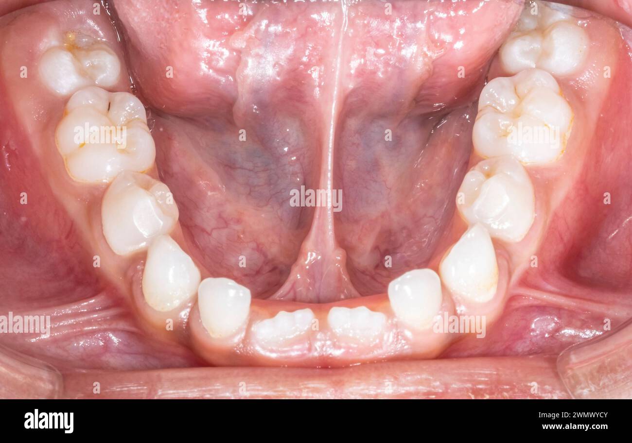 Mandibular arch occlusal view of a child milky dentition and permanent incisors erupting, tongue lifted with voluminous lingual frenum. Stock Photo